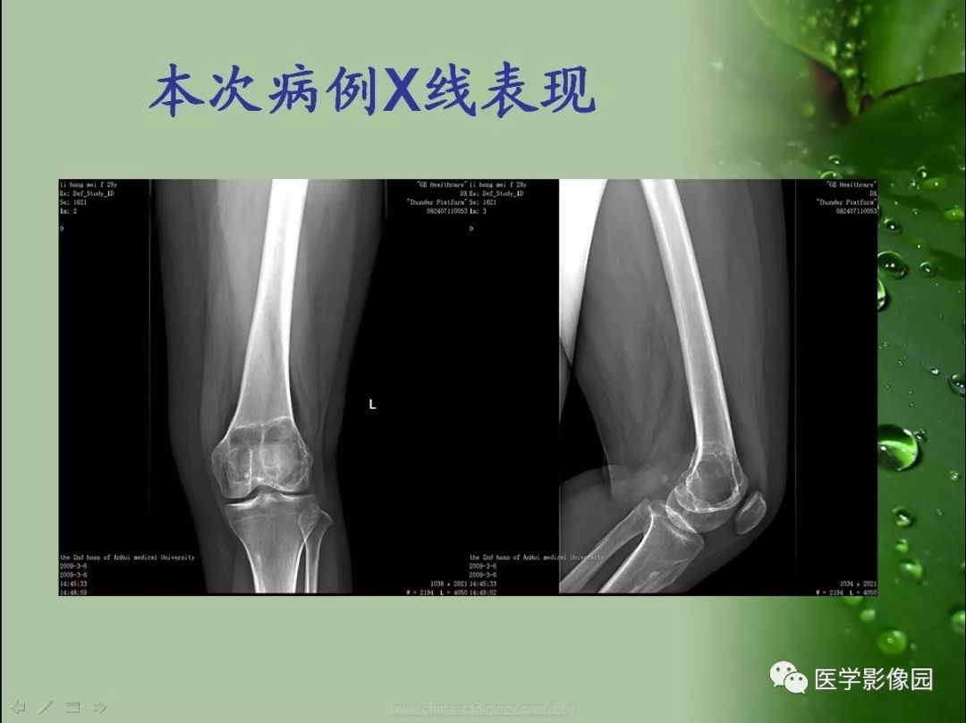 【病例】骨巨细胞瘤1例CT及MR影像表现