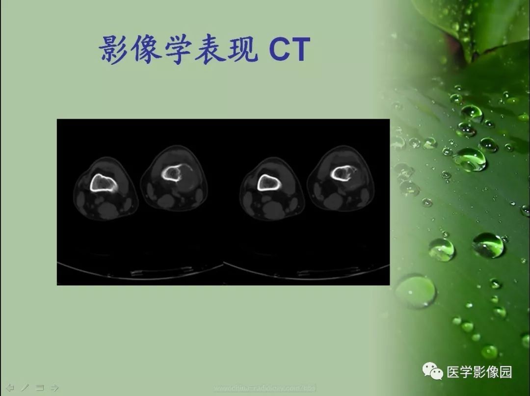【病例】骨巨细胞瘤1例CT及MR影像表现