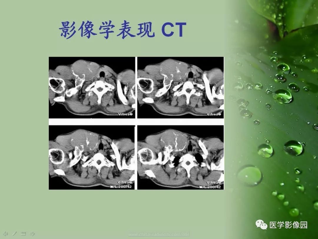 【病例】骨巨细胞瘤1例CT及MR影像表现