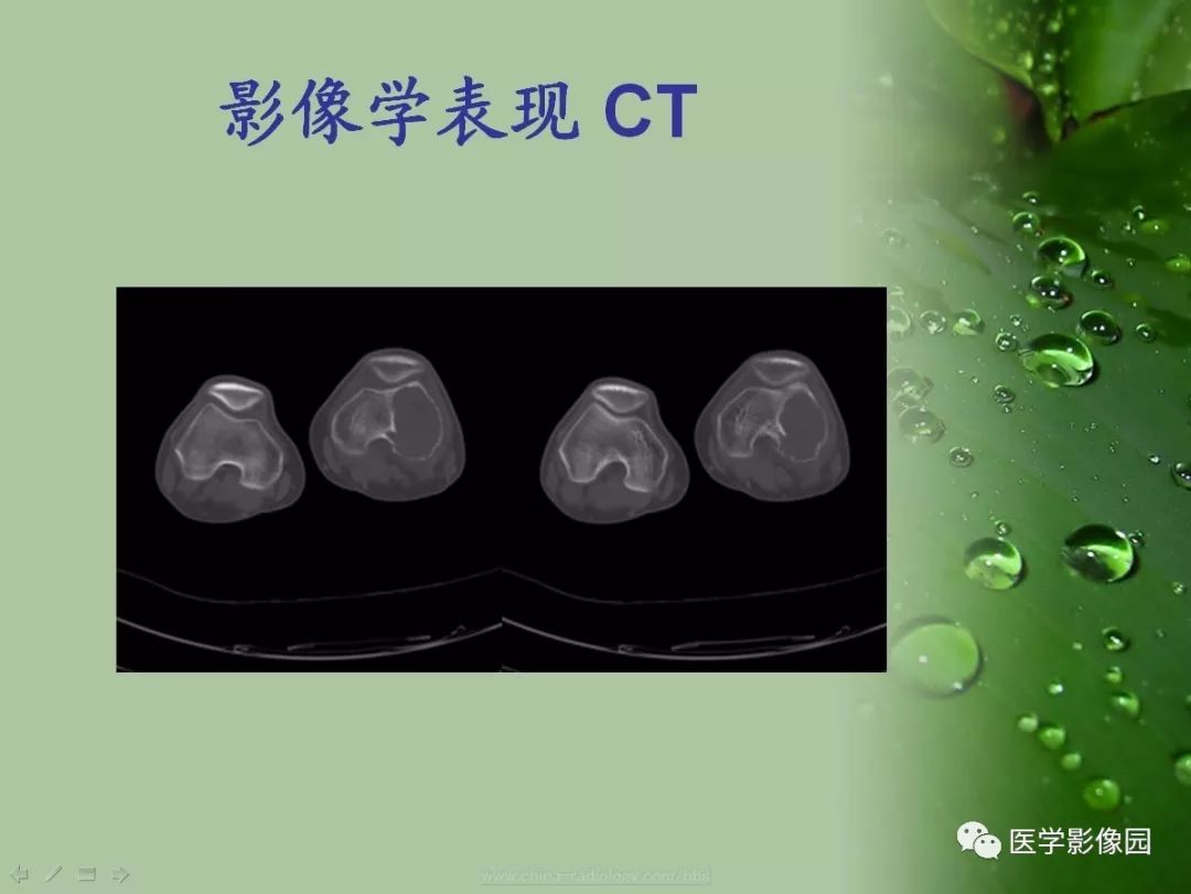 【病例】骨巨细胞瘤1例CT及MR影像表现
