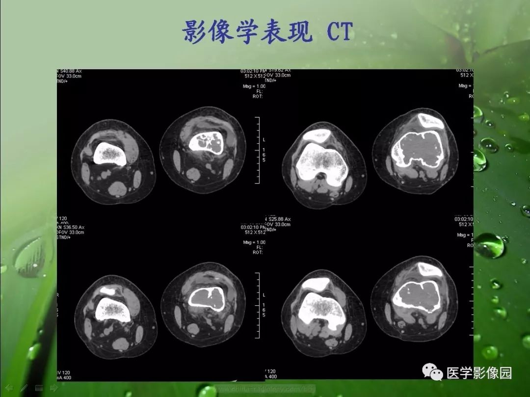 【病例】骨巨细胞瘤1例CT及MR影像表现