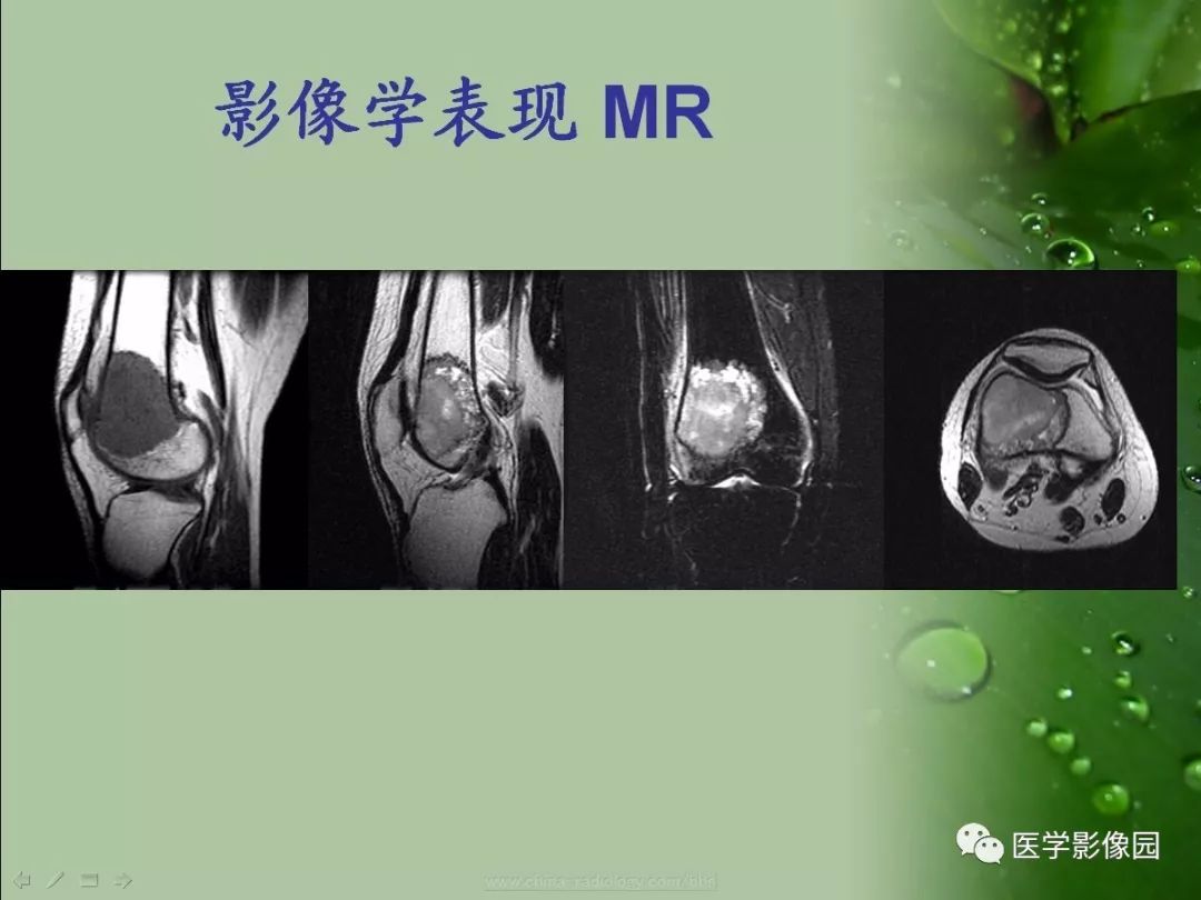 【病例】骨巨细胞瘤1例CT及MR影像表现