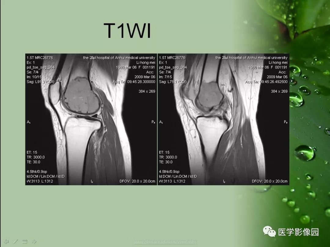 【病例】骨巨细胞瘤1例CT及MR影像表现