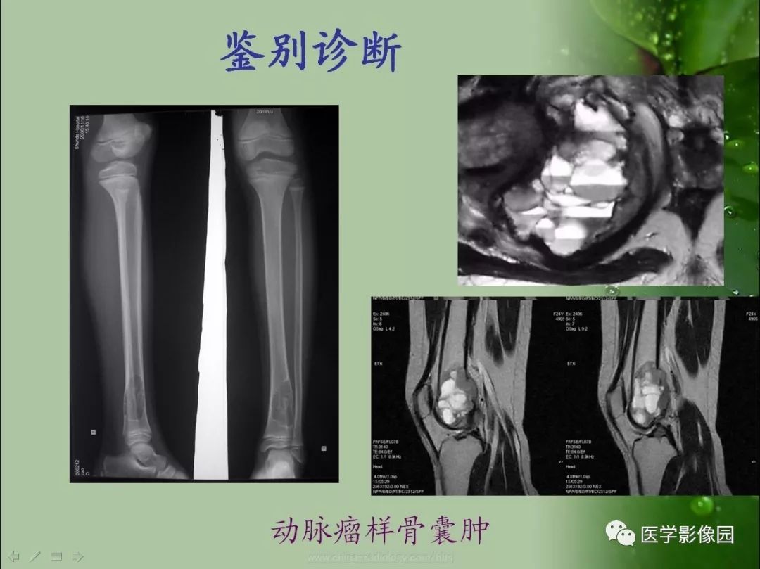 【病例】骨巨细胞瘤1例CT及MR影像表现