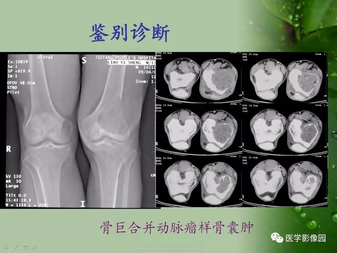 【病例】骨巨细胞瘤1例CT及MR影像表现