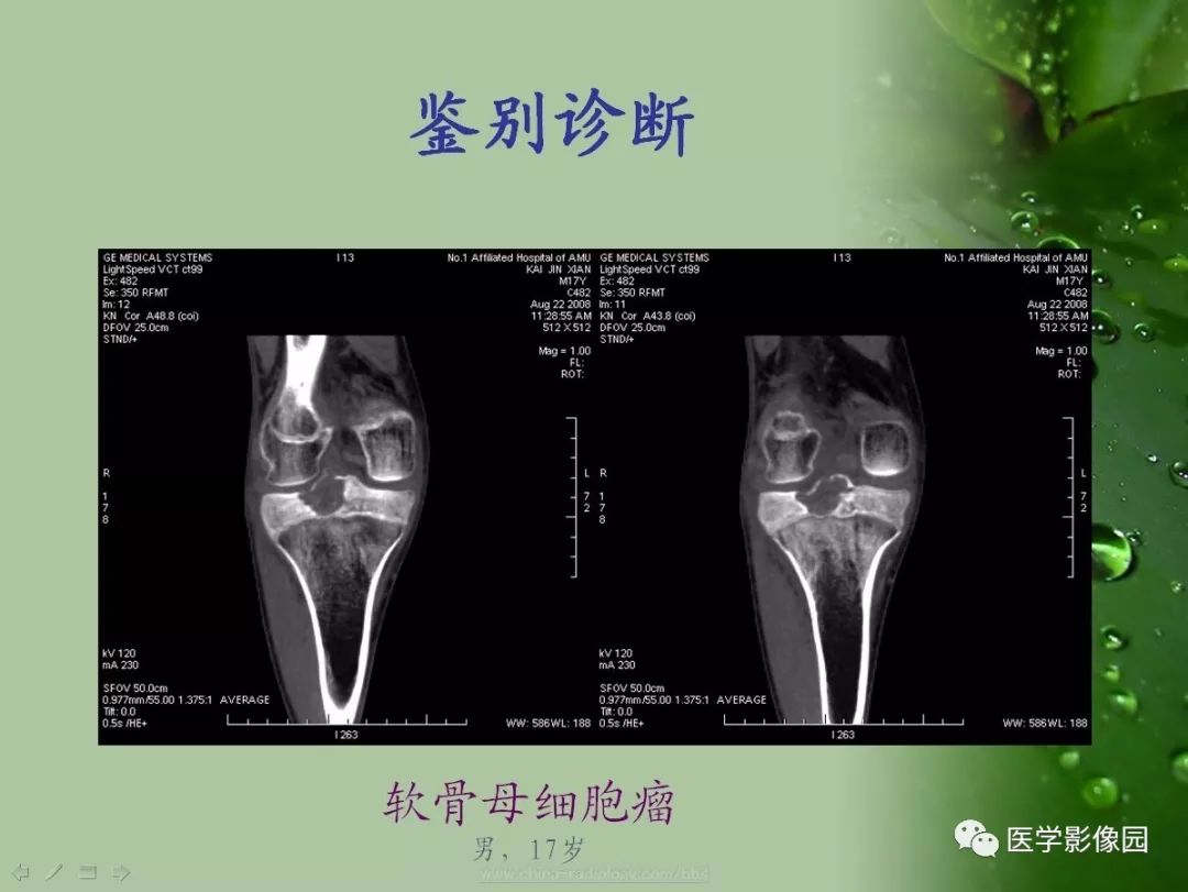 【病例】骨巨细胞瘤1例CT及MR影像表现