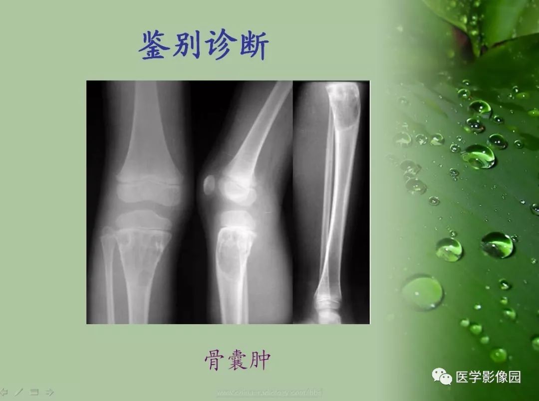【病例】骨巨细胞瘤1例CT及MR影像表现