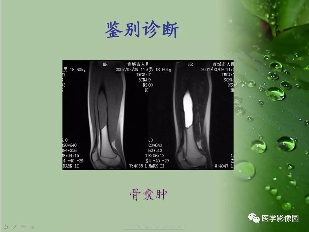 【病例】骨巨细胞瘤1例CT及MR影像表现