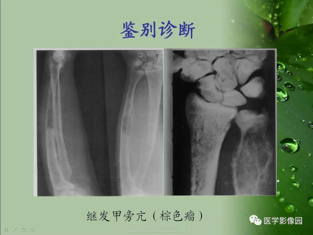 【病例】骨巨细胞瘤1例CT及MR影像表现