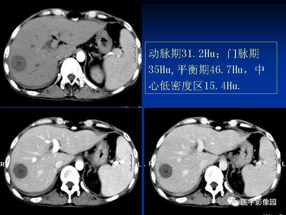 【PPT】肝脏结核CT表现