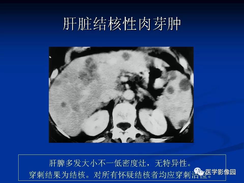 【PPT】肝脏结核CT表现