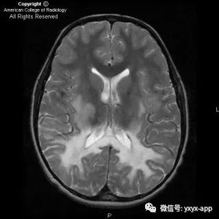 【病例】肾上腺脑白质营养不良1例影像诊断分析