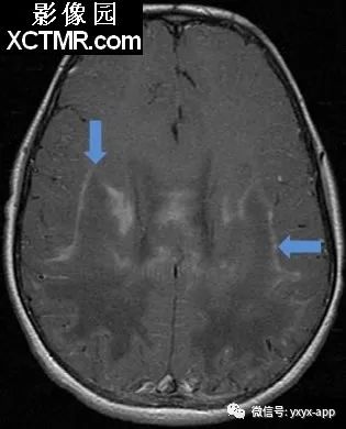 【病例】肾上腺脑白质营养不良1例影像诊断分析