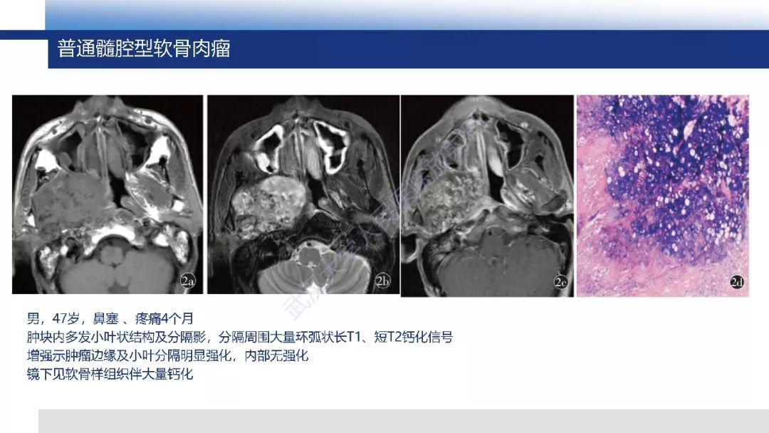 【PPT】软骨肉瘤影像诊断