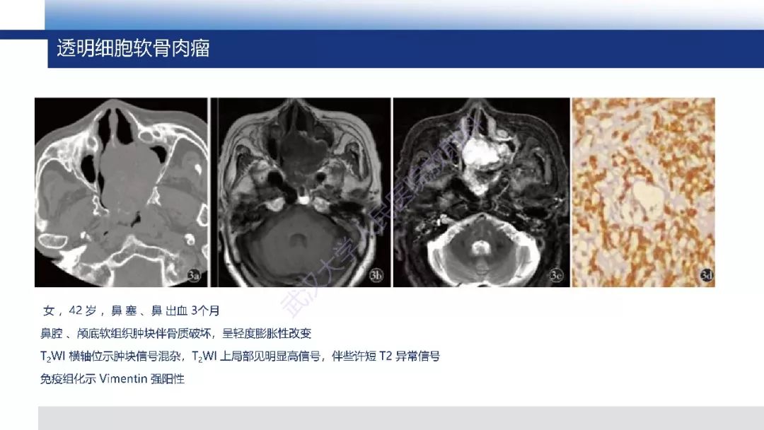 【PPT】软骨肉瘤影像诊断