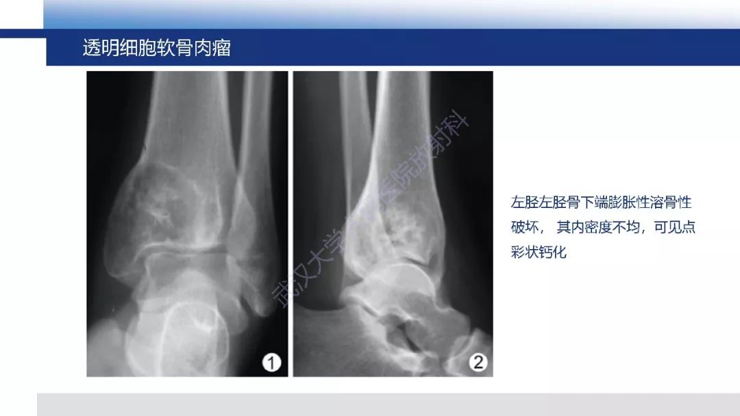 【PPT】软骨肉瘤影像诊断
