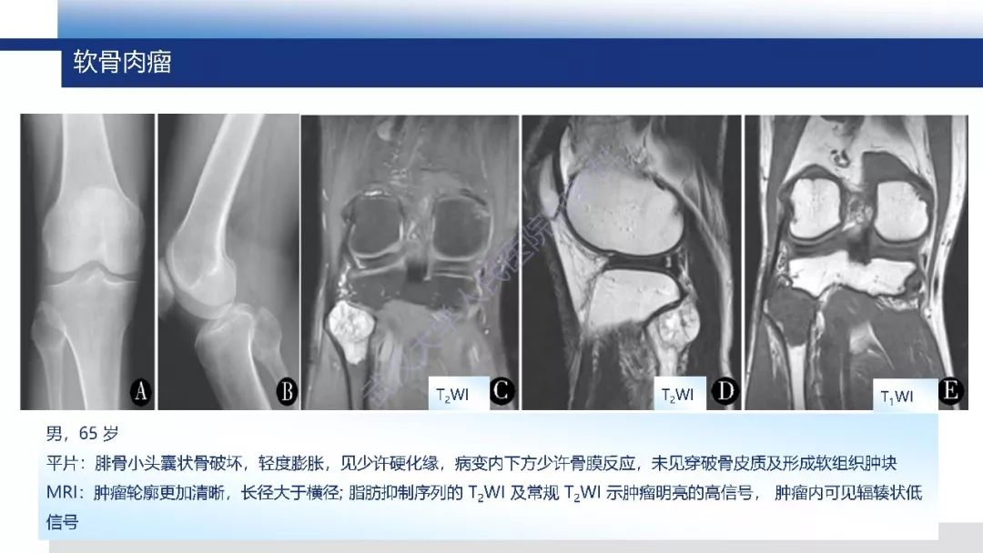 【PPT】软骨肉瘤影像诊断