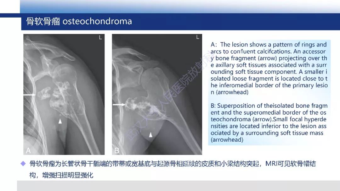 【PPT】软骨肉瘤影像诊断