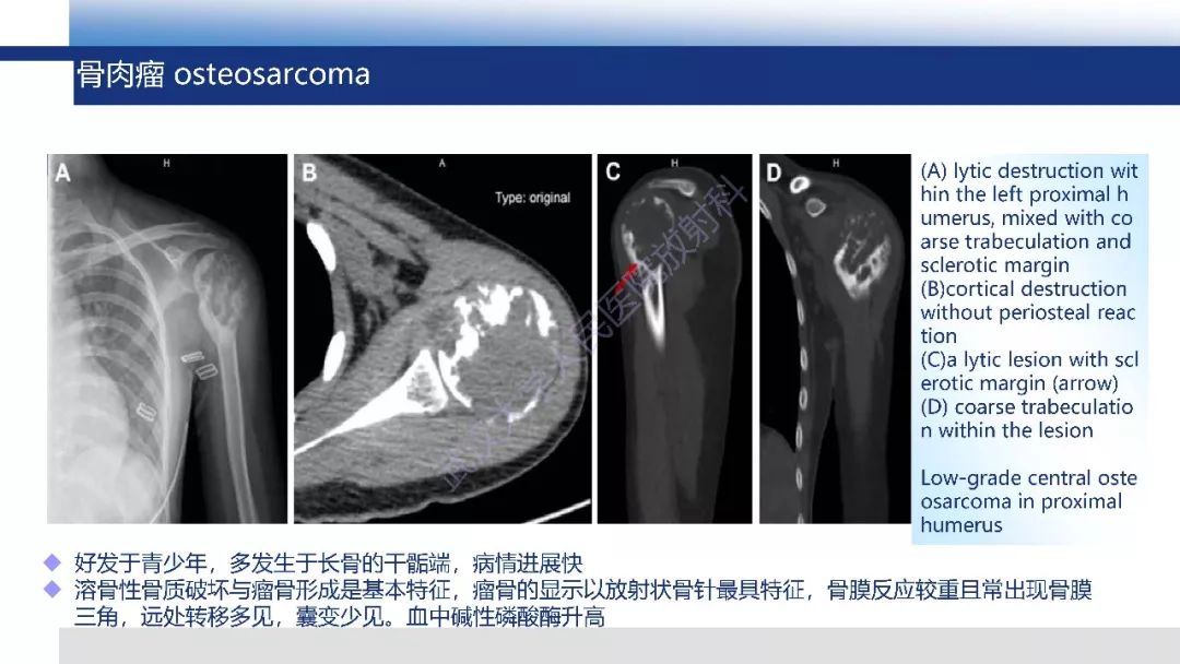 【PPT】软骨肉瘤影像诊断