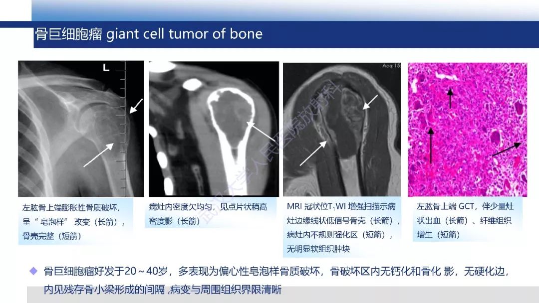 【PPT】软骨肉瘤影像诊断