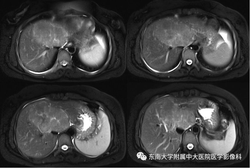 【病例】肝脏局灶性结节增生FNH一例MR