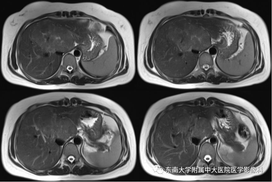 【病例】肝脏局灶性结节增生FNH一例MR