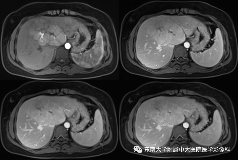 【病例】肝脏局灶性结节增生FNH一例MR
