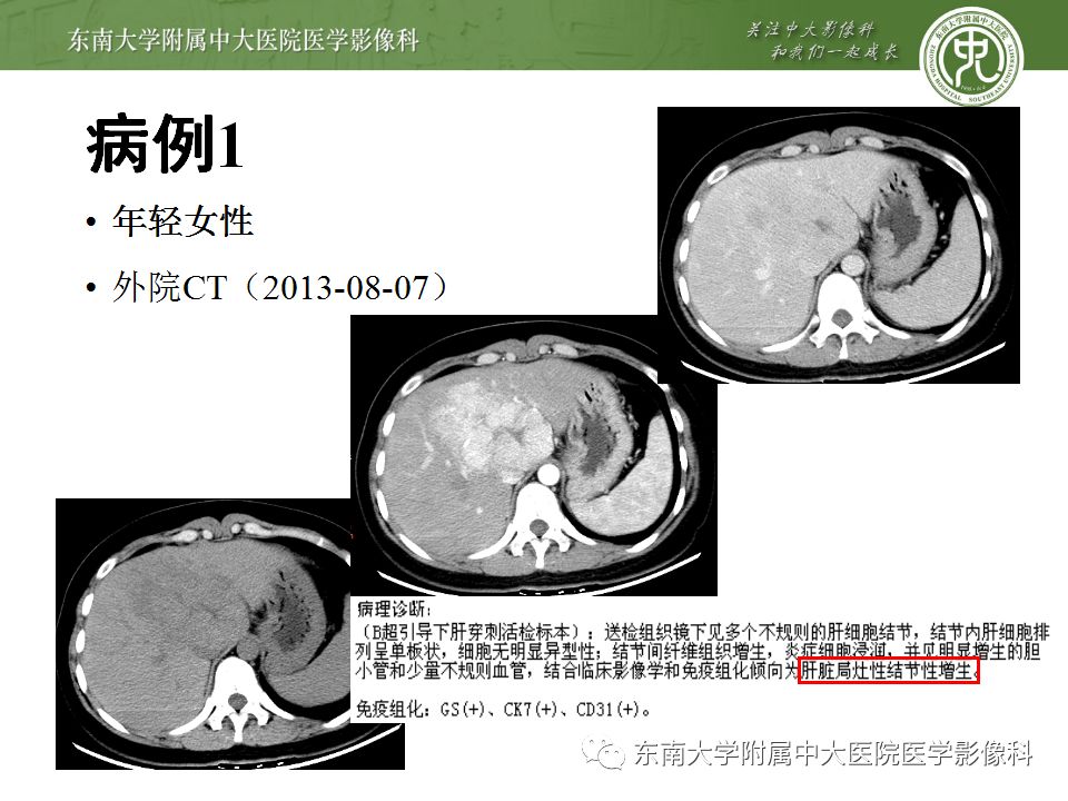 【病例】肝脏局灶性结节增生FNH一例MR