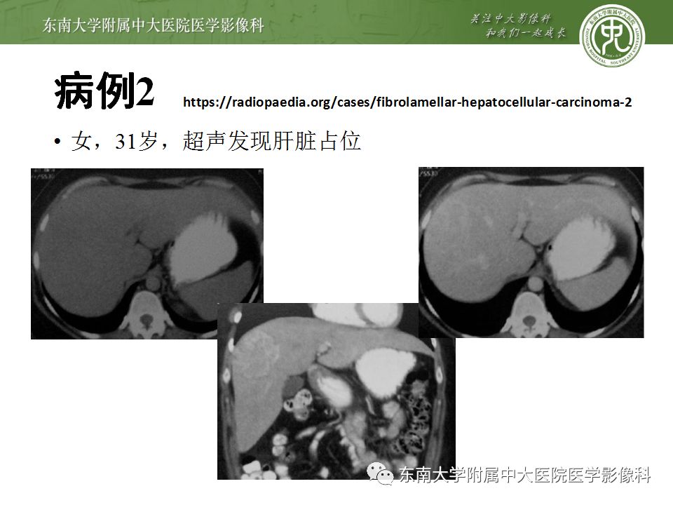 【病例】肝脏局灶性结节增生FNH一例MR