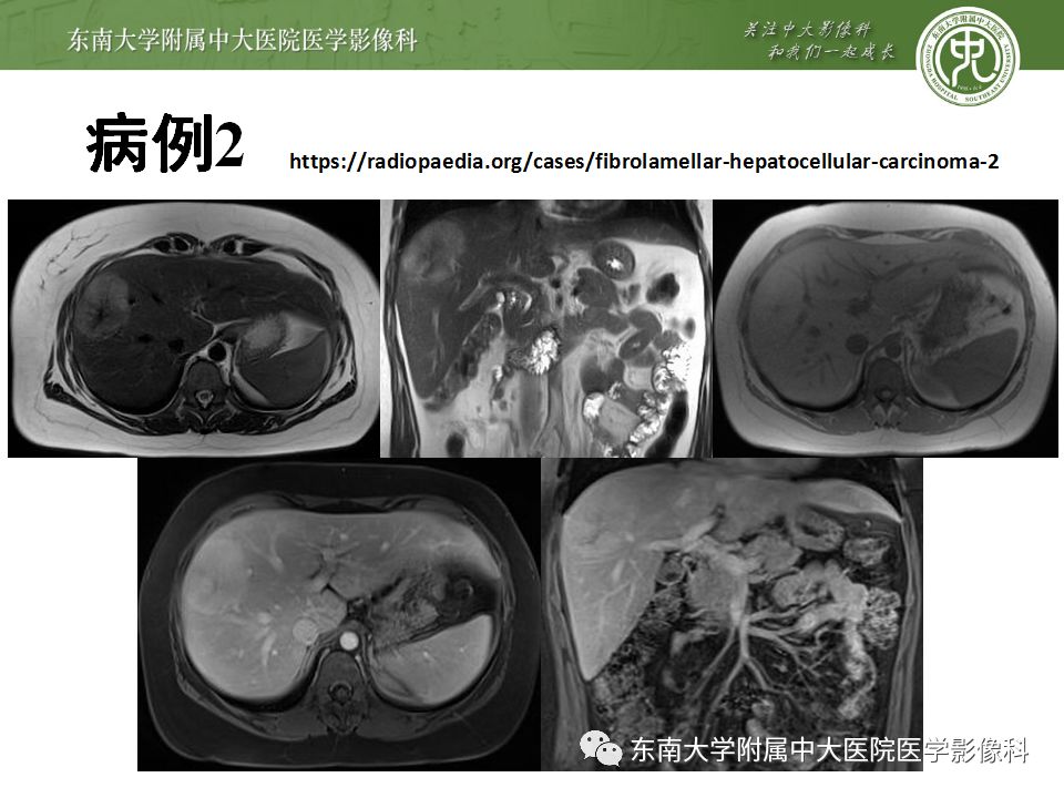 【病例】肝脏局灶性结节增生FNH一例MR