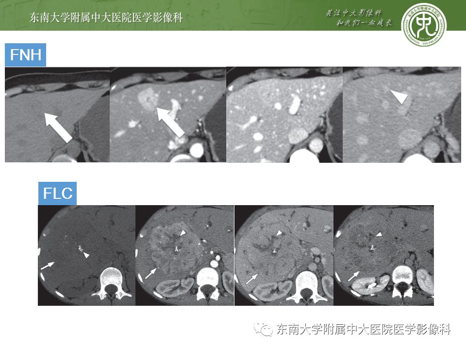 【病例】肝脏局灶性结节增生FNH一例MR