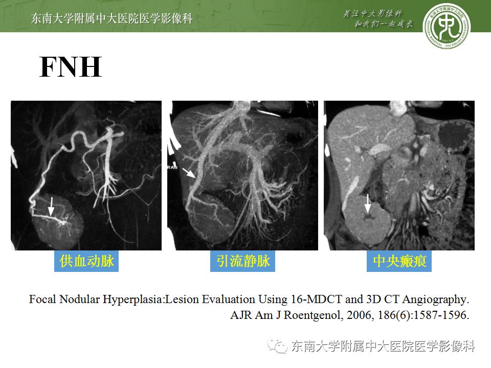 【病例】肝脏局灶性结节增生FNH一例MR