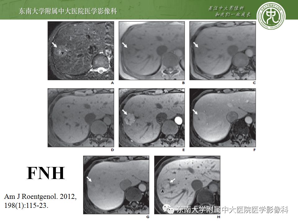 【病例】肝脏局灶性结节增生FNH一例MR