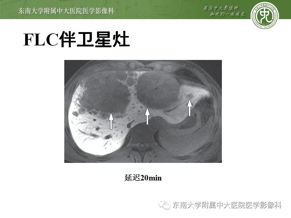 【病例】肝脏局灶性结节增生FNH一例MR