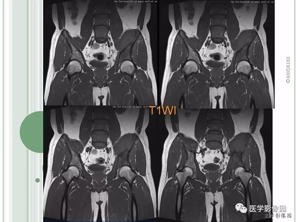 【病例】髂骨恶性淋巴瘤1例CT及MR