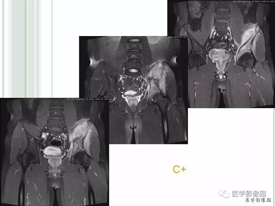 【病例】髂骨恶性淋巴瘤1例CT及MR