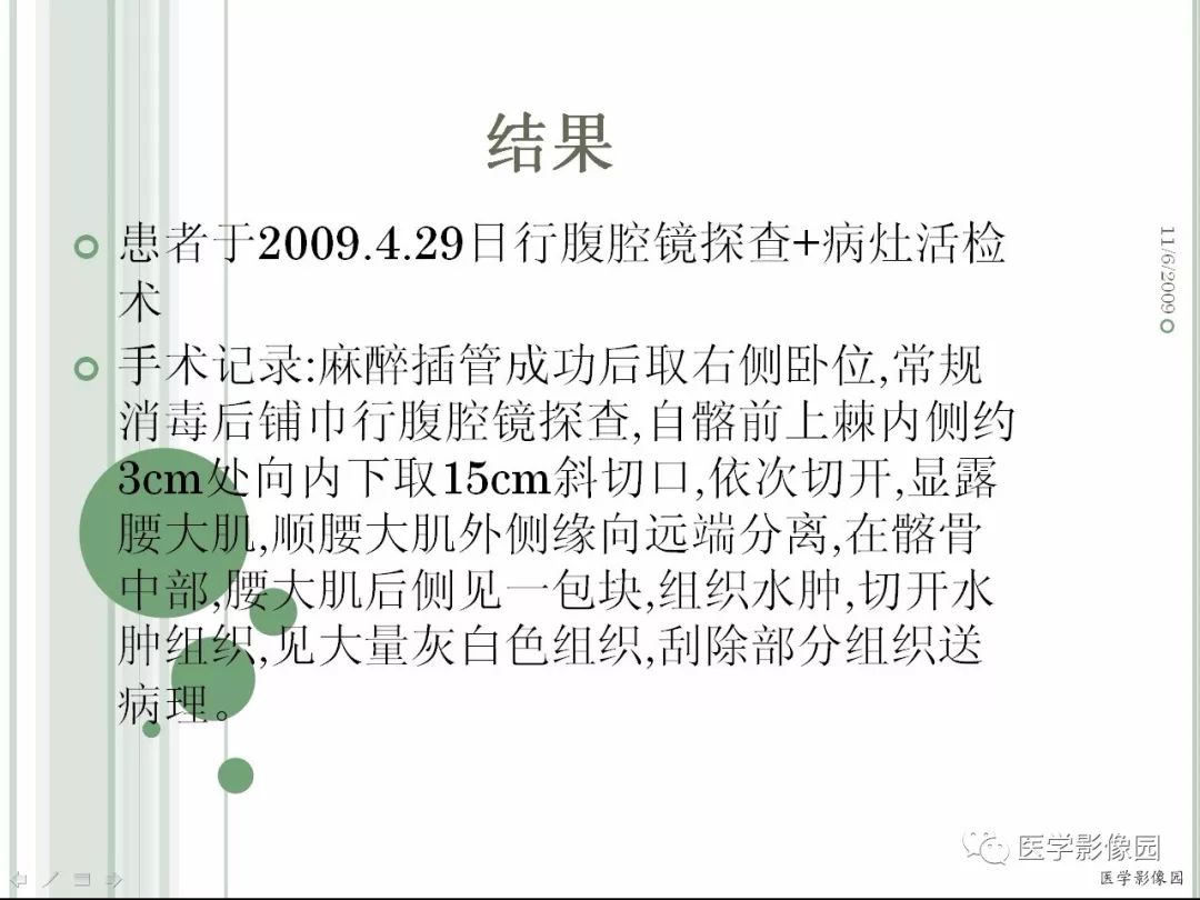 【病例】髂骨恶性淋巴瘤1例CT及MR