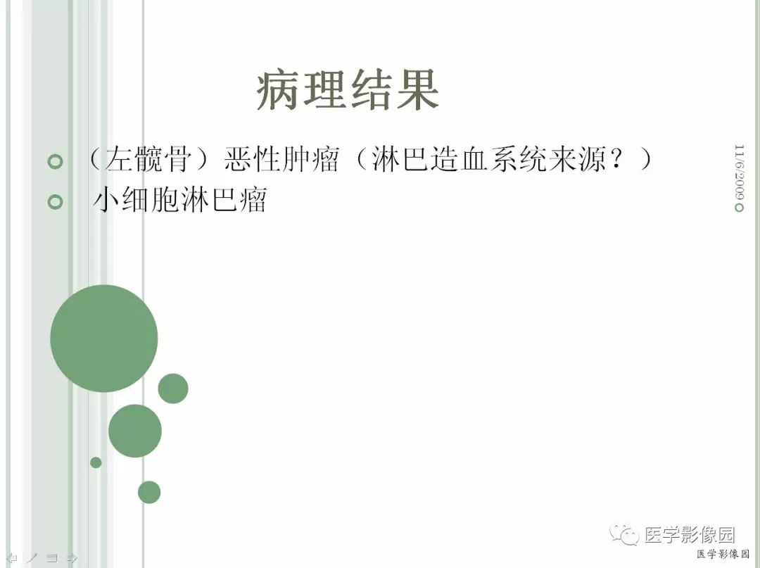 【病例】髂骨恶性淋巴瘤1例CT及MR