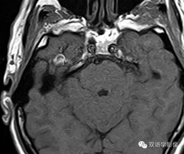 【病例】颈内动脉岩段动脉瘤1例MR及CT 【病例】颈内动脉岩段动脉瘤1例MR及CT