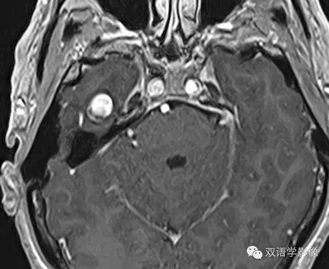 【病例】颈内动脉岩段动脉瘤1例MR及CT 【病例】颈内动脉岩段动脉瘤1例MR及CT