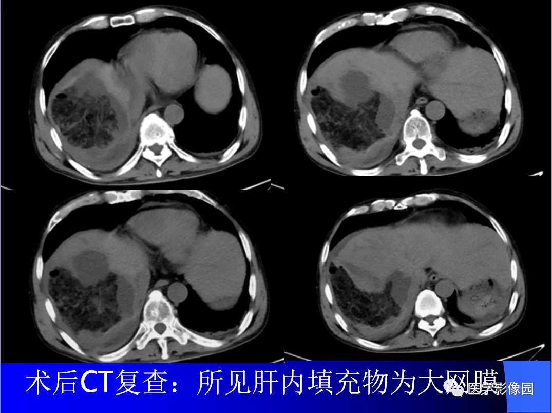 【病例】肝包虫病1例CT