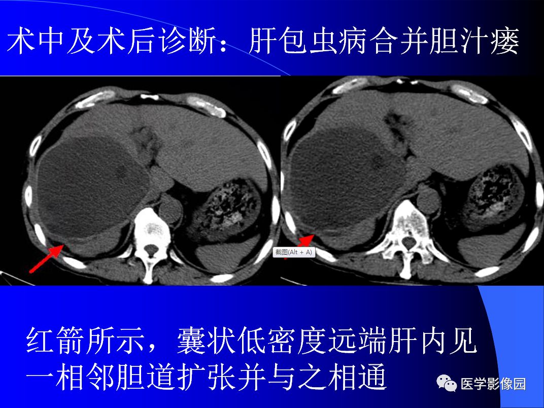 【病例】肝包虫病1例CT
