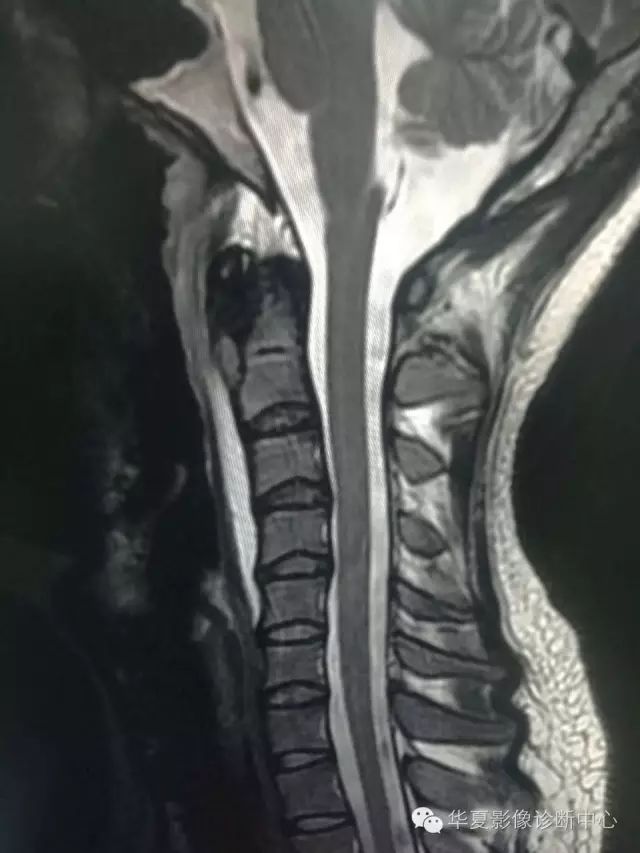 终于知道颈椎椎前液体密度/信号怎么诊断了