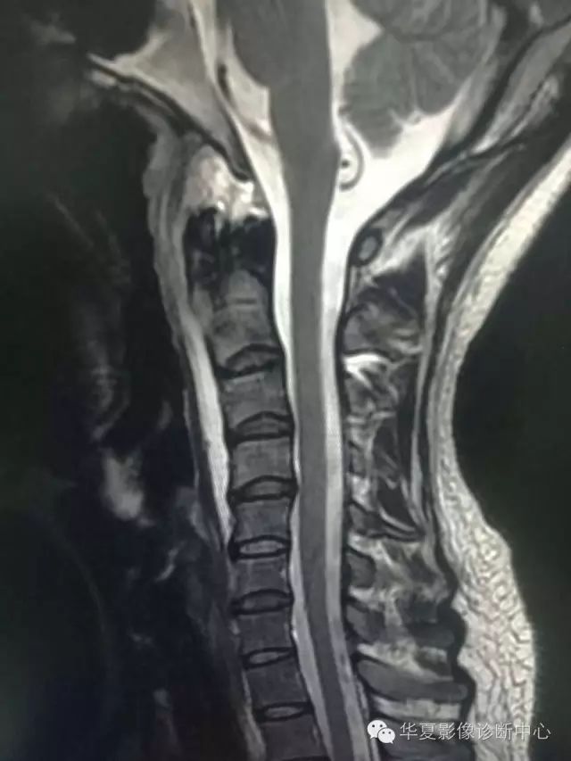 终于知道颈椎椎前液体密度/信号怎么诊断了