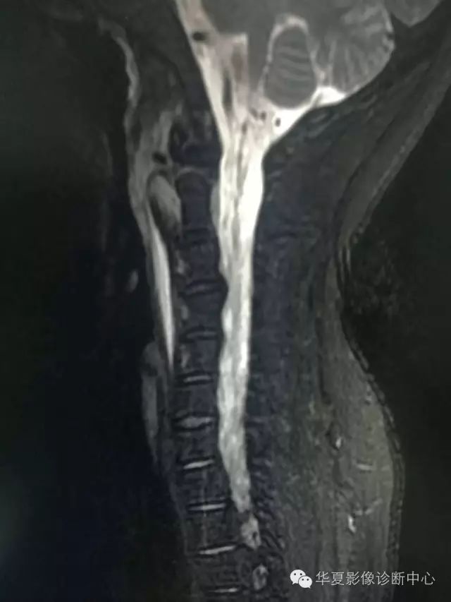 终于知道颈椎椎前液体密度/信号怎么诊断了