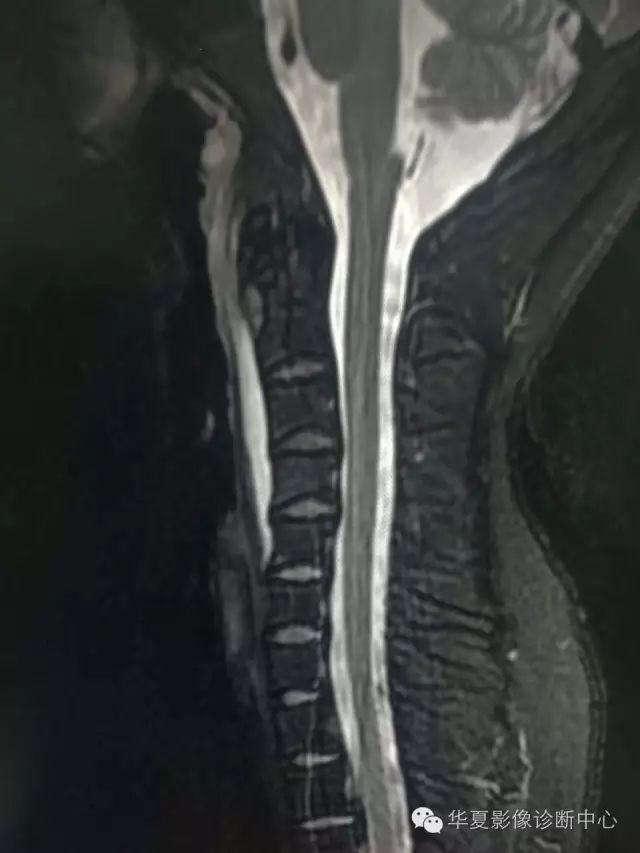 终于知道颈椎椎前液体密度/信号怎么诊断了