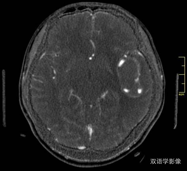 【病例】巨大蛇形动脉瘤1例