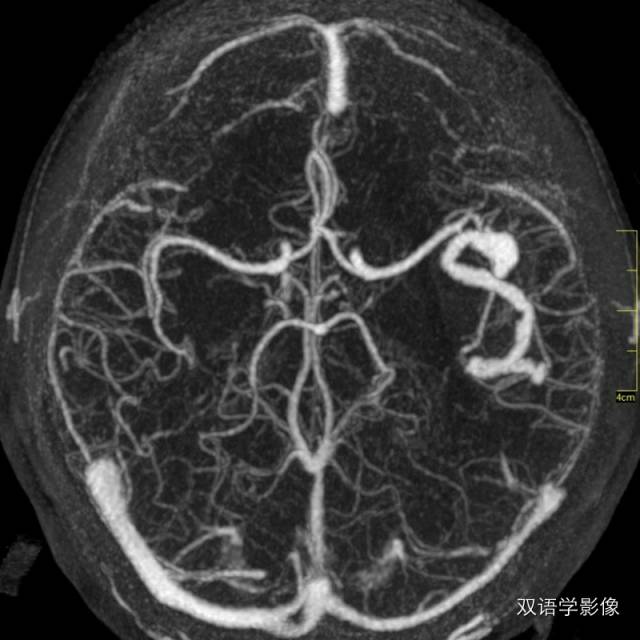 【病例】巨大蛇形动脉瘤1例