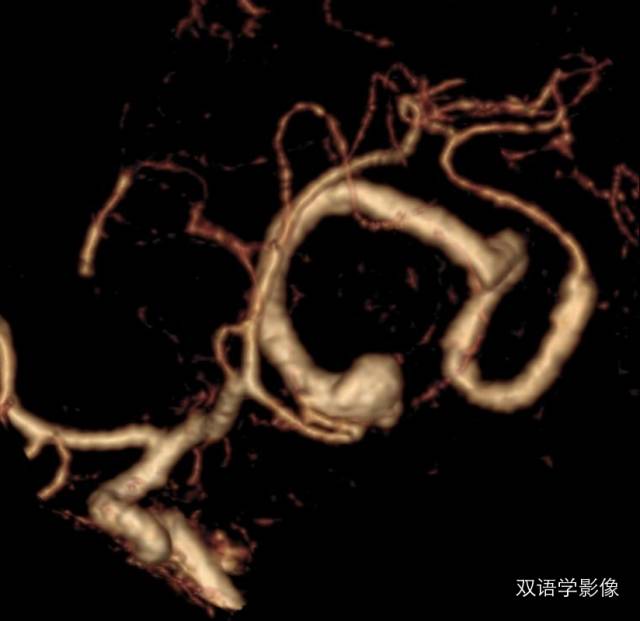 【病例】巨大蛇形动脉瘤1例