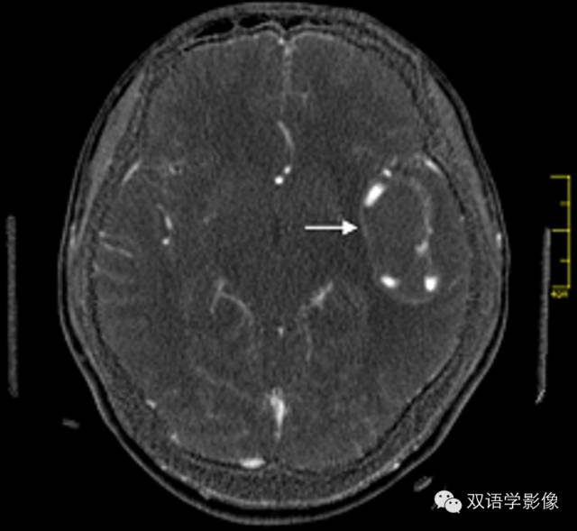 【病例】巨大蛇形动脉瘤1例
